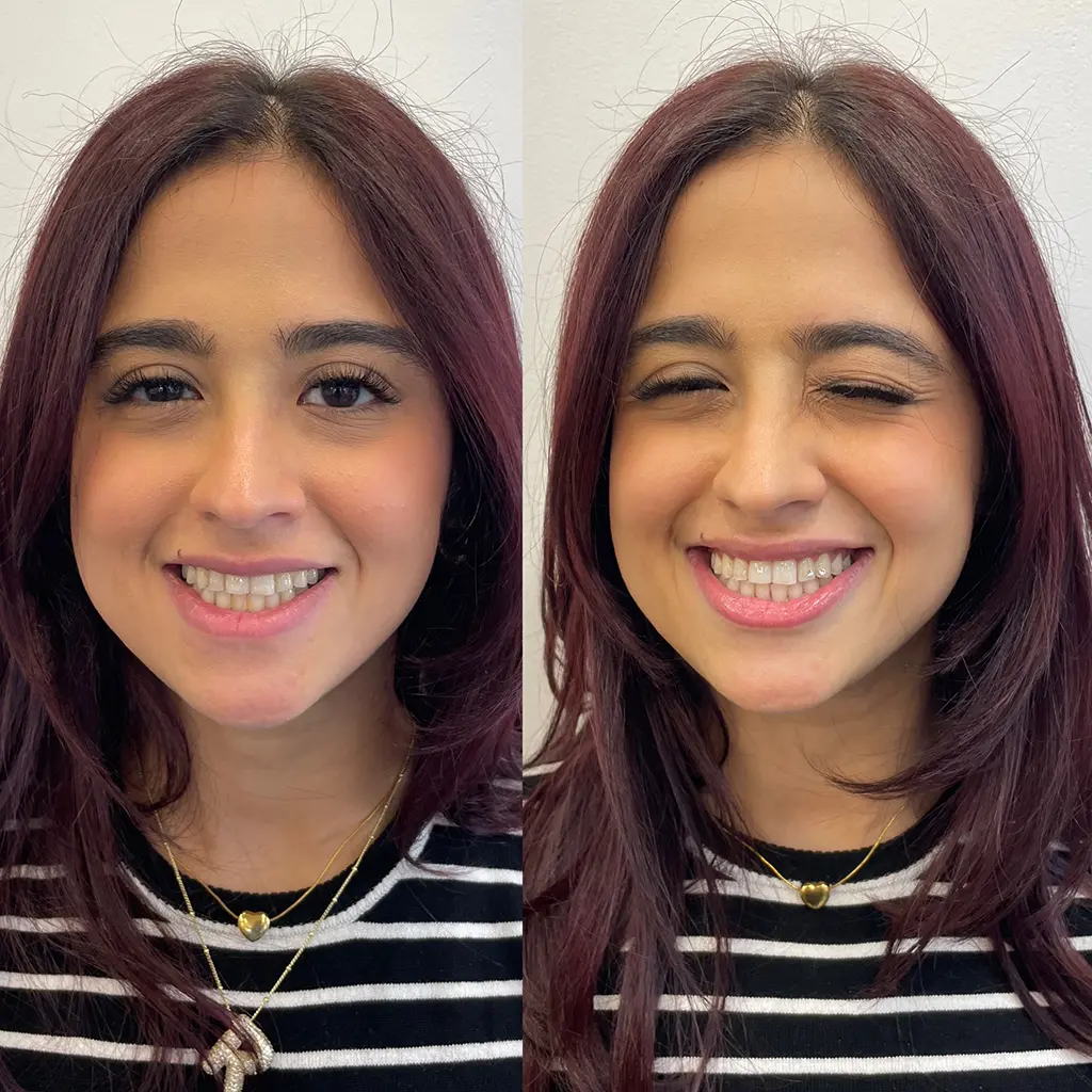 Instant Teeth Whitening Treatment