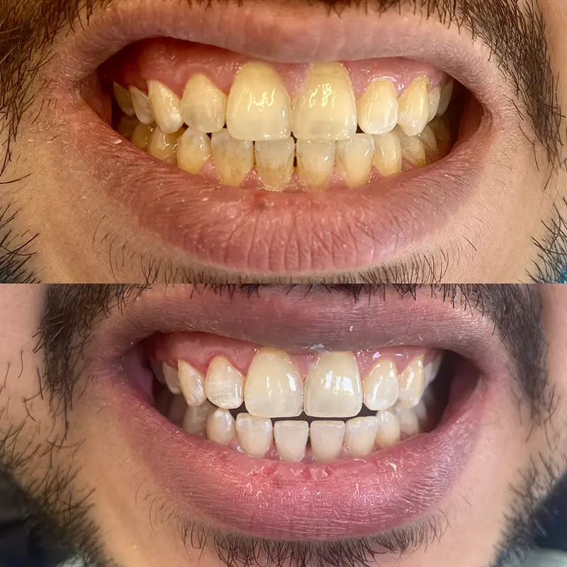 Instant Teeth Whitening Treatment