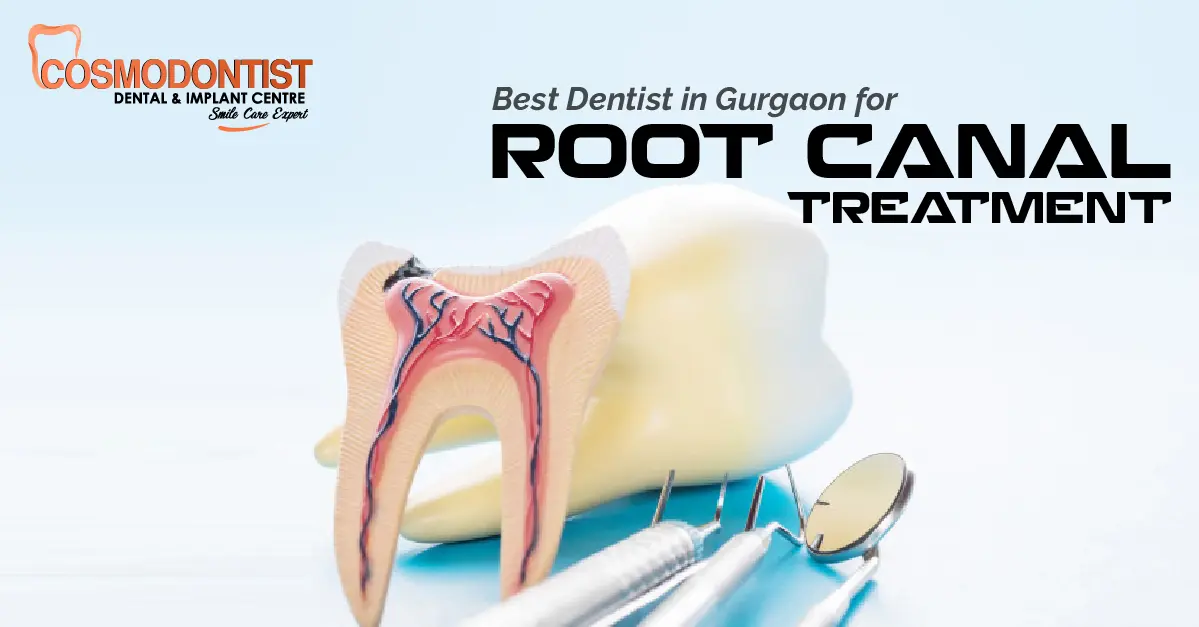 Best Dentist in Gurgaon for Root Canal Treatment