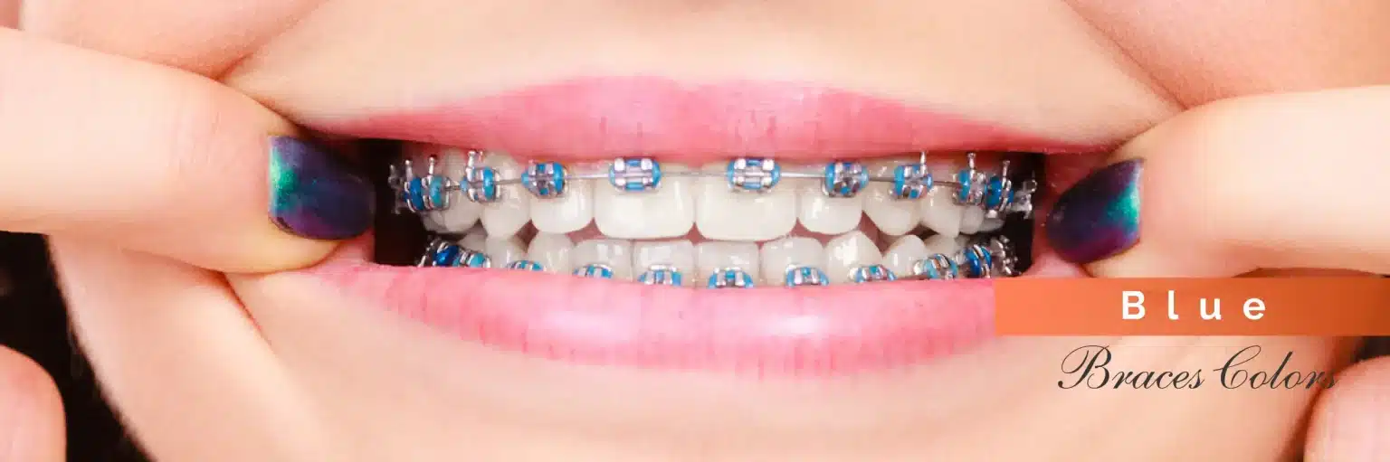 Invisalign Initial Consultation