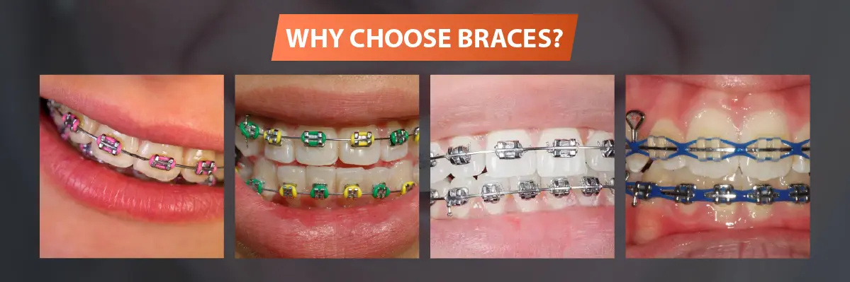 Invisalign Initial Consultation