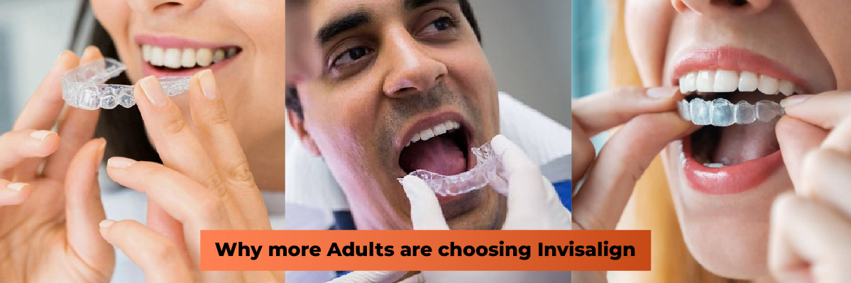 Invisalign Initial Consultation