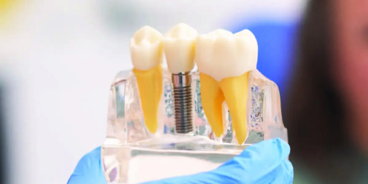 Dental Implant Cost in Gurgaon