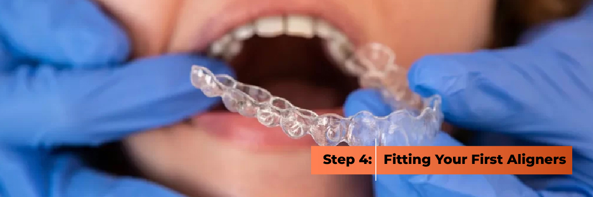 First Fitting of Invisalign Aligners