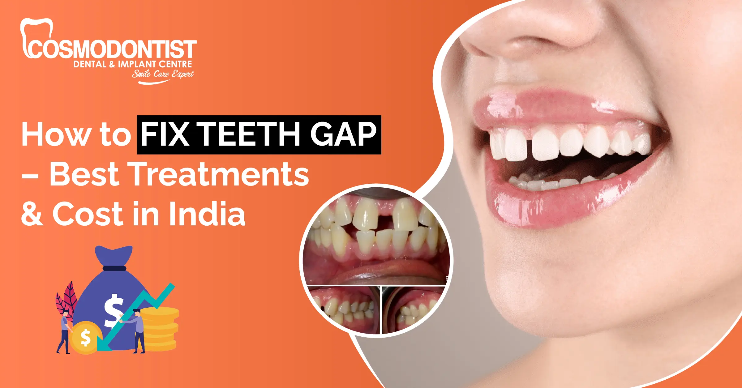 How to Fix Teeth Gap