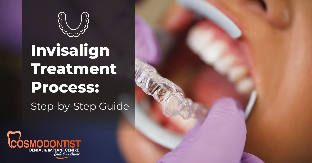 Invisalign Treatment Process: Step-by-Step Guide
