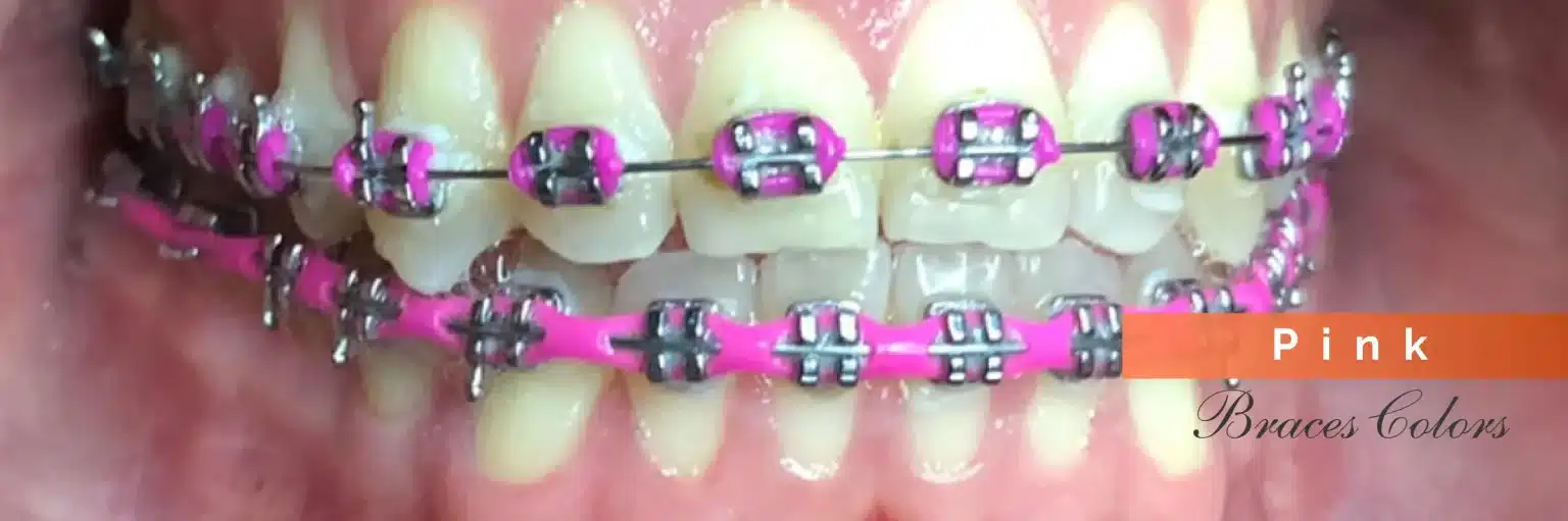 Invisalign Initial Consultation