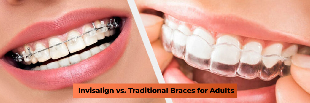 Invisalign Initial Consultation