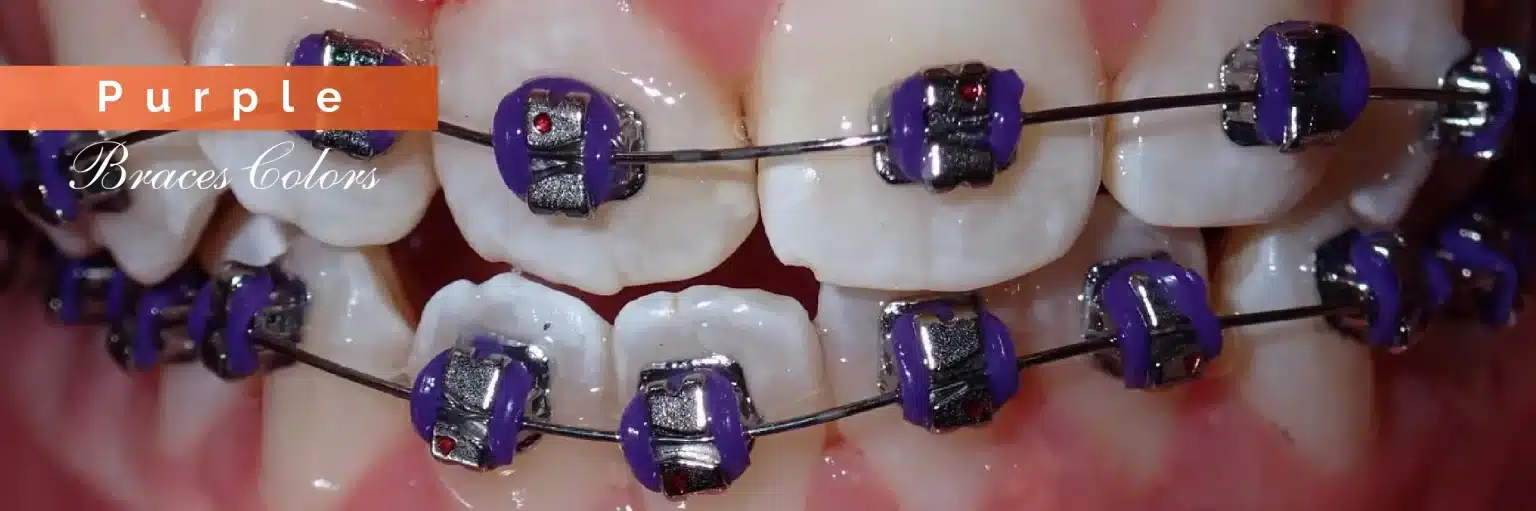 Invisalign Initial Consultation