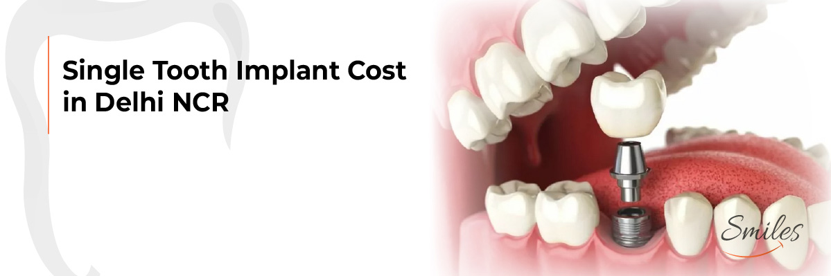 Invisalign Initial Consultation
