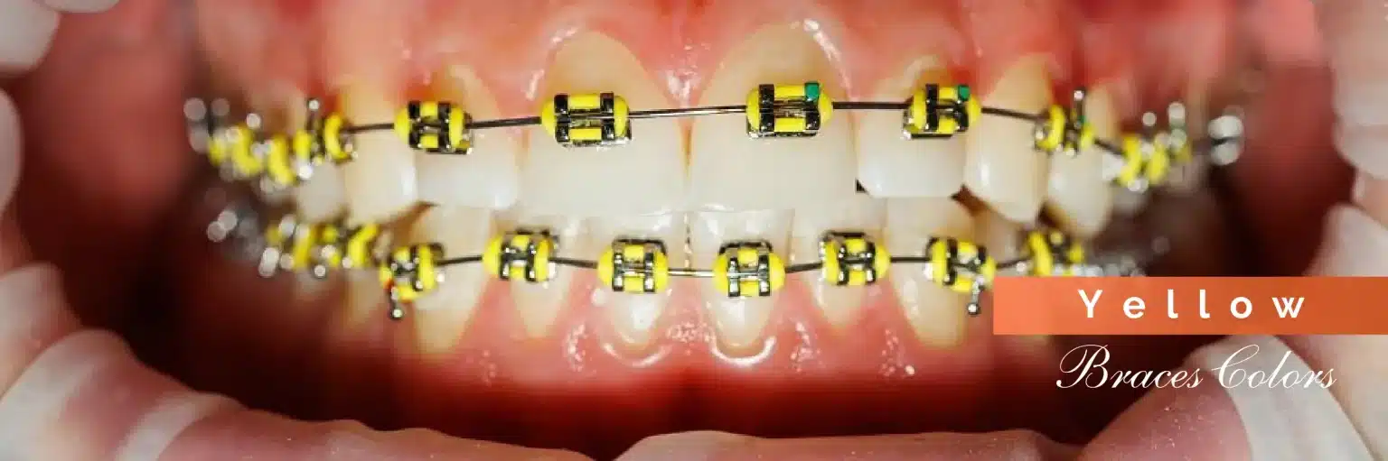 Invisalign Initial Consultation
