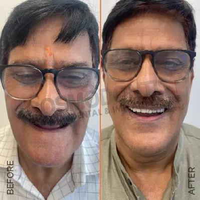 before after