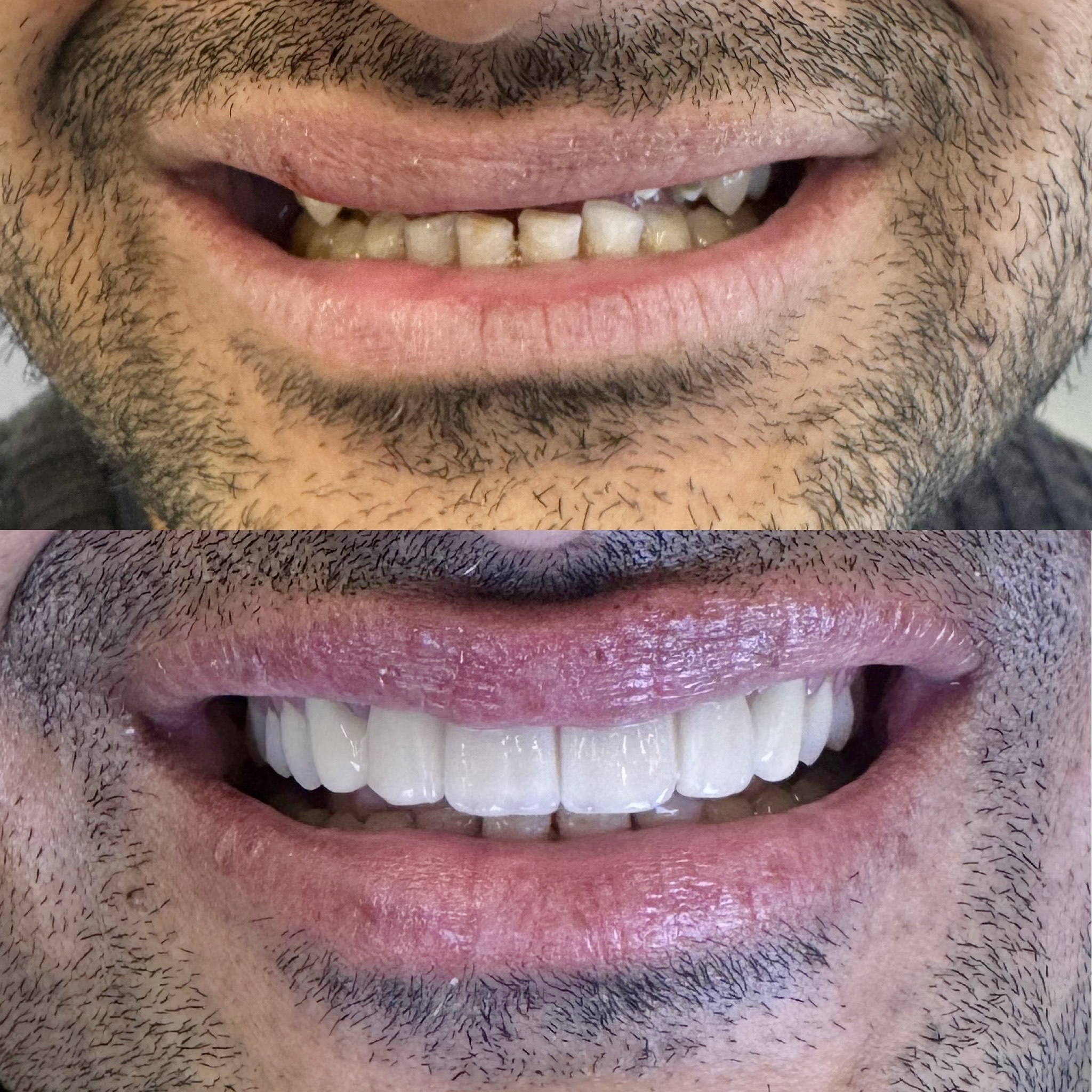 before after