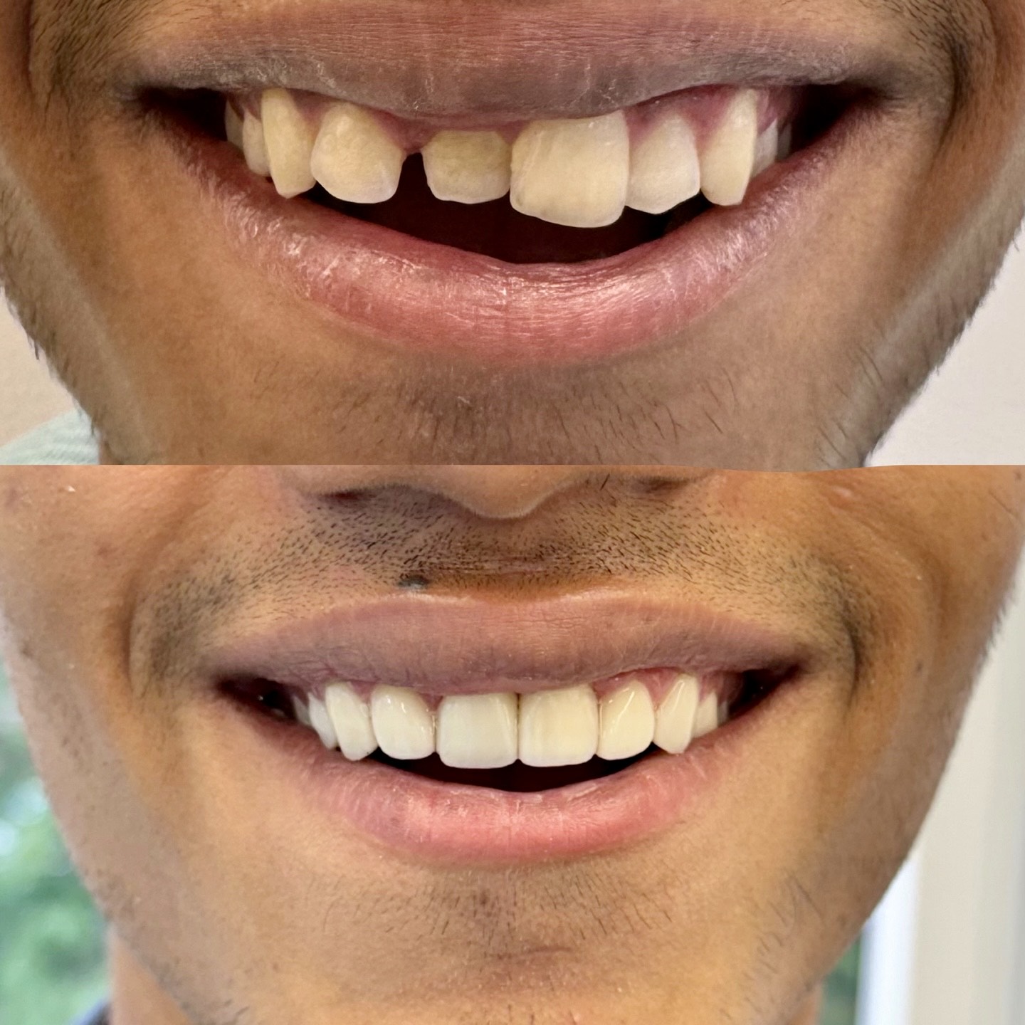 before after