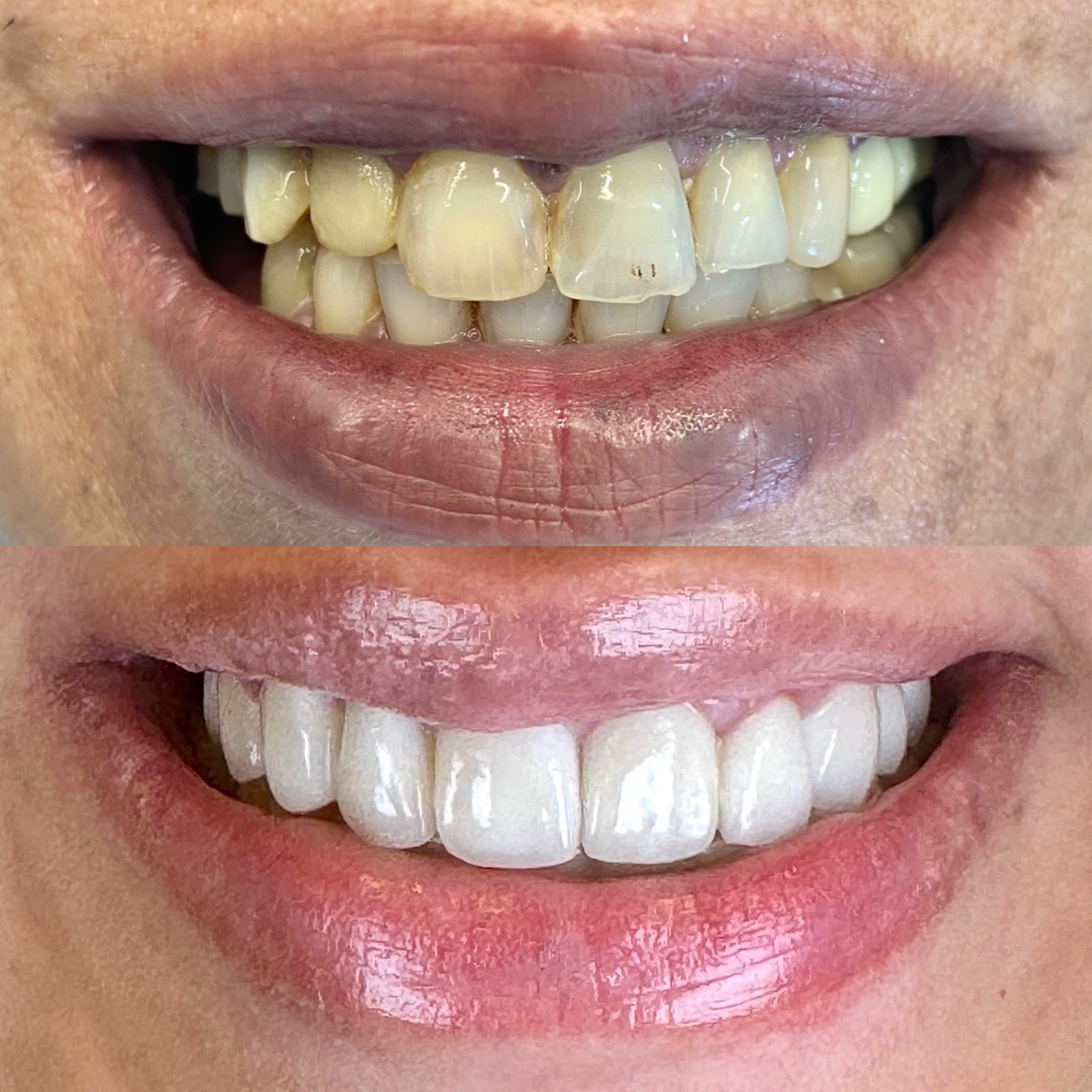before after