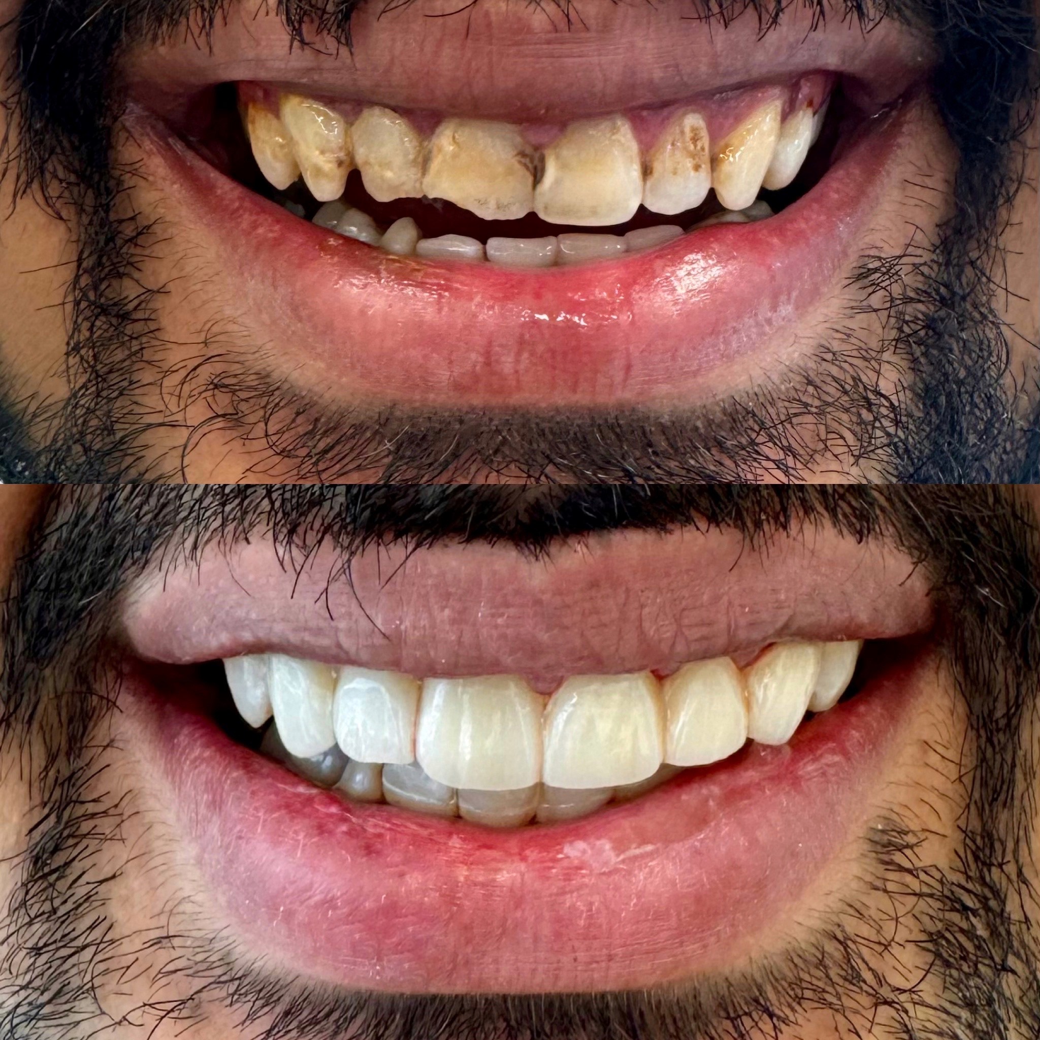 before after