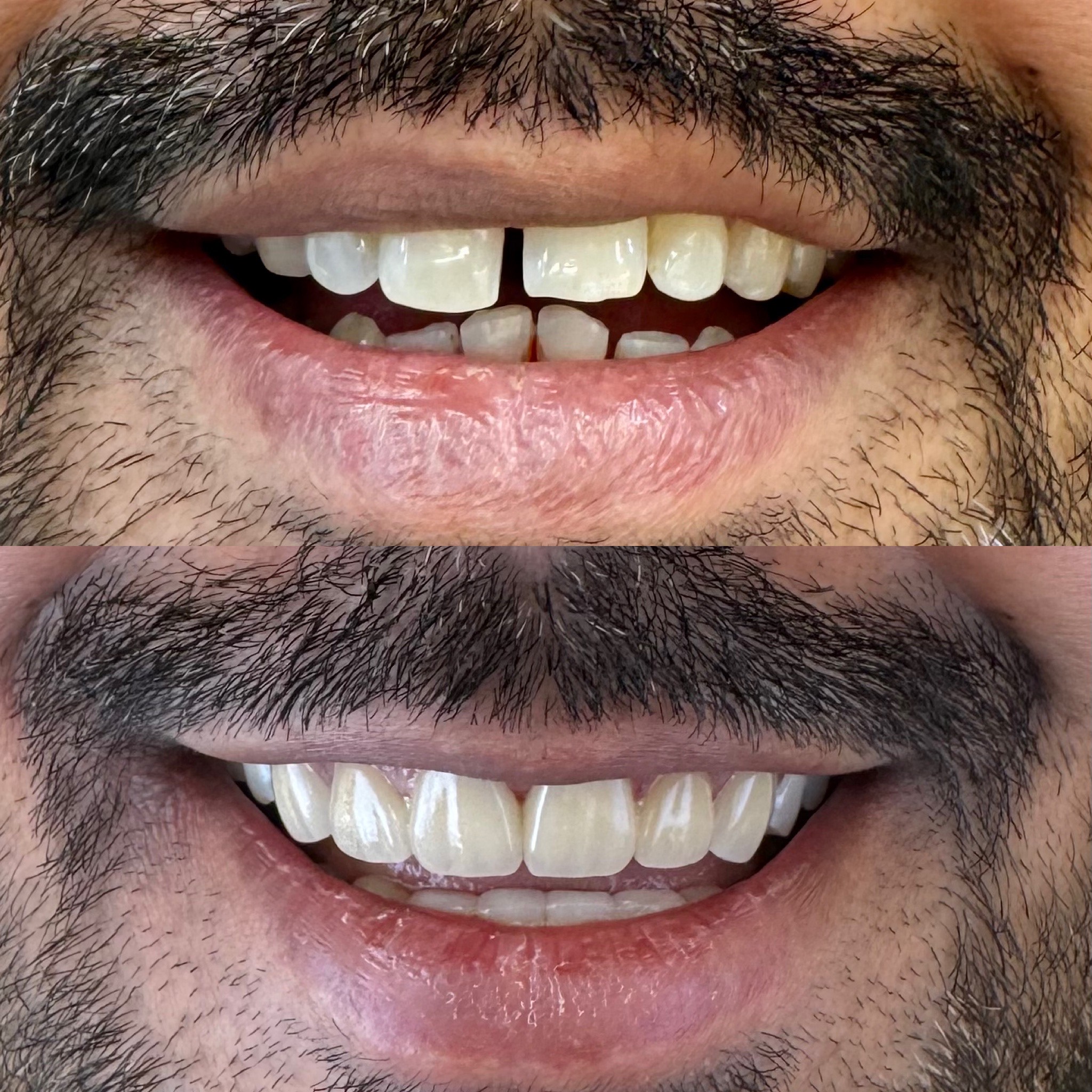 before after