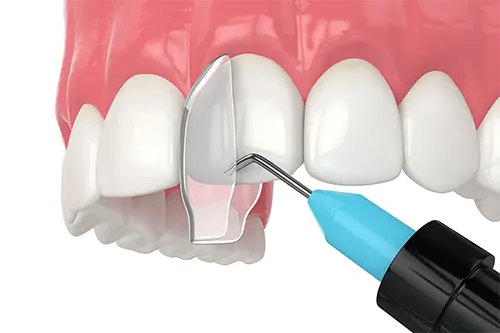 Dental bonding
