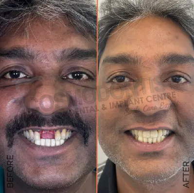 before treatment