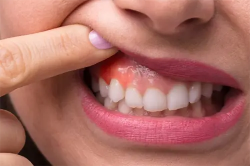 Gum contouring