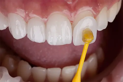 Porcelain veneers