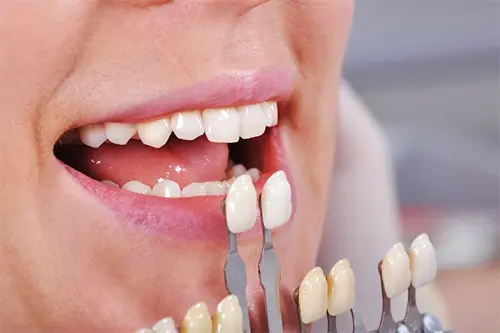 Tooth contouring
