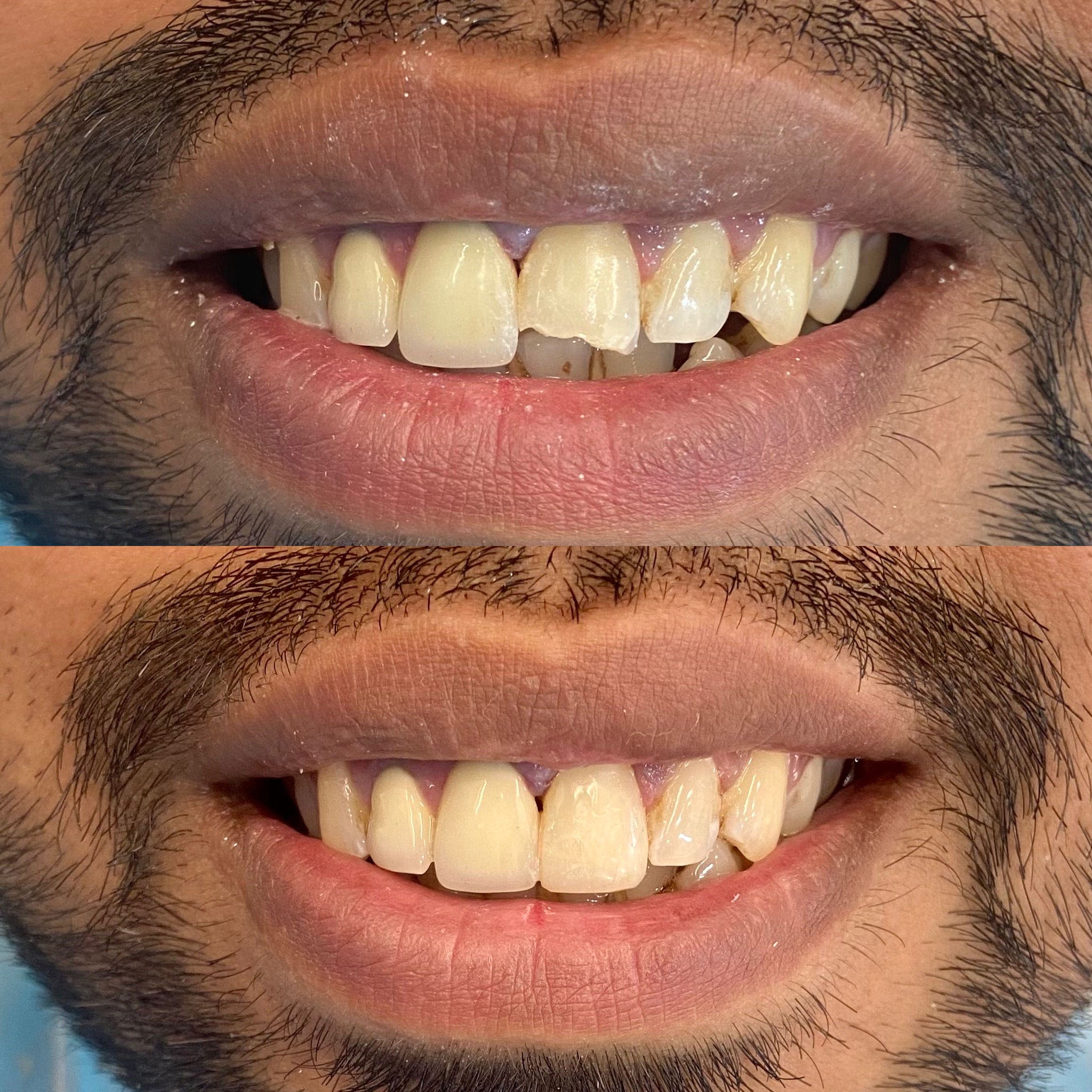 Tooth-colored dental bonding illustration