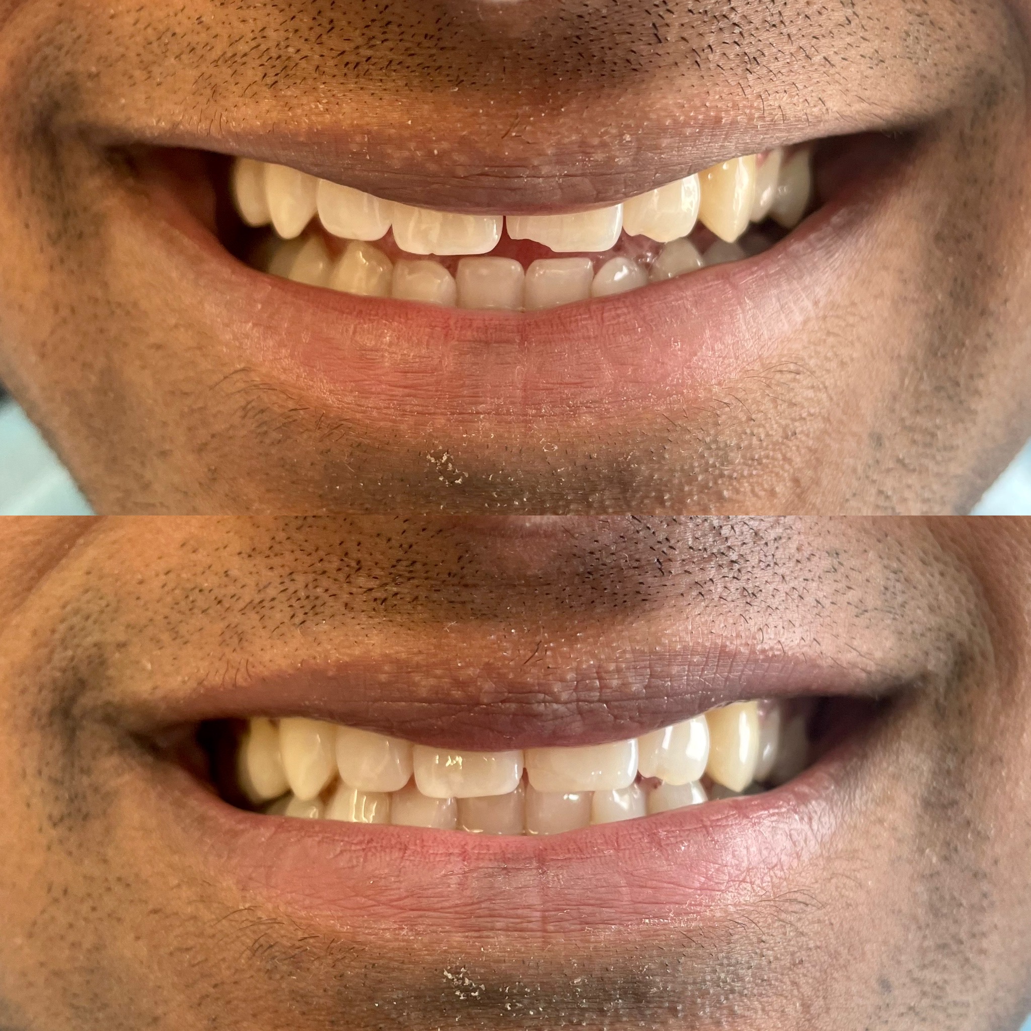 Tooth-colored restoration treatment illustration