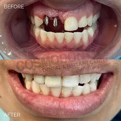 Dental Implants