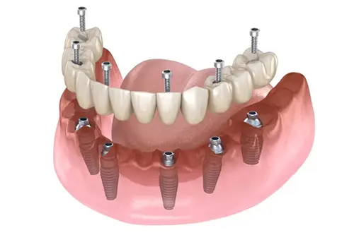 All-on-6 Dental Implants