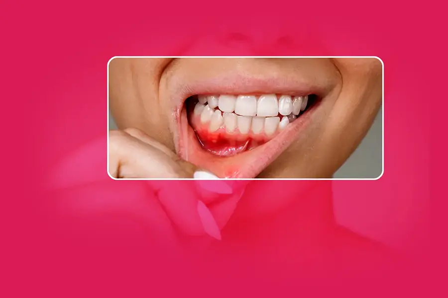 Gum Treatment in Gurgaon