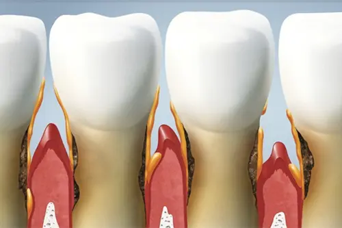 Reduced bone loss