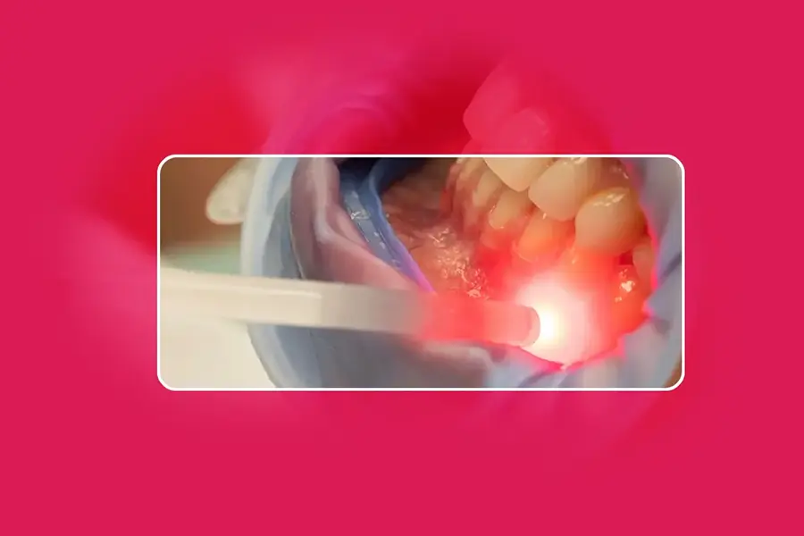 
Laser Dental Treatment in Gurgaon, India