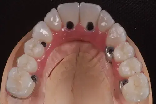 Creating access hole during root canal procedure at Cosmodontist Clinic