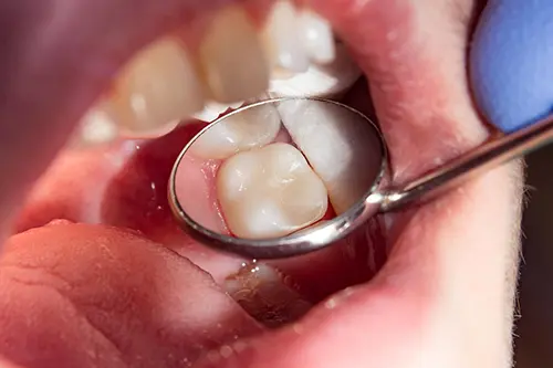 Filling canals during root canal treatment at Cosmodontist Clinic