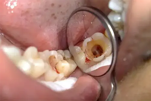Pulp removal during root canal treatment at Cosmodontist Clinic