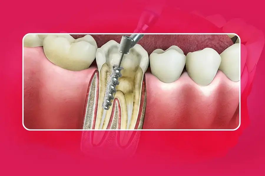 Root canal treatment at Cosmodontist Dental Clinic
