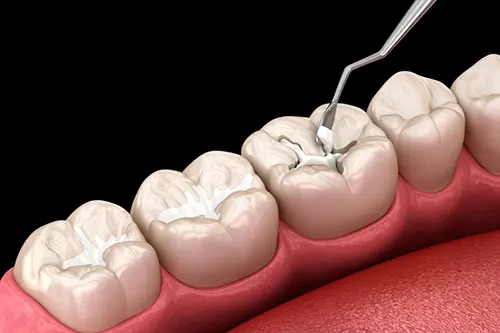 Sealing the tooth after root canal treatment at Cosmodontist Clinic