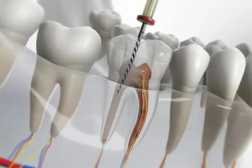 Shaping canals during root canal treatment at Cosmodontist Clinic