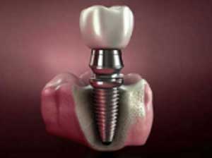 Dental Implant Treatment