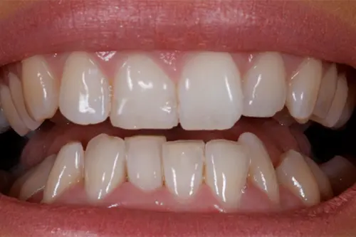 Teeth alignment and spacing correction illustration for smile designing at Cosmodontist Clinic