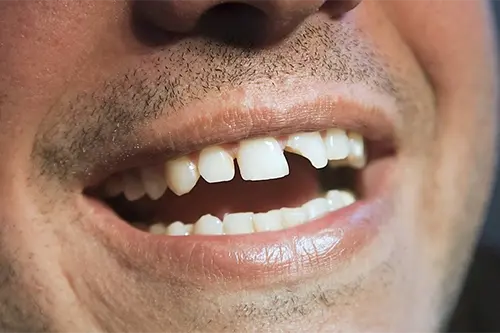 Broken or chipped teeth correction illustration for smile designing at Cosmodontist Clinic