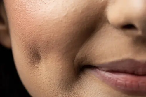 Cheeks and smile enhancement illustration