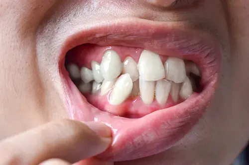 Crooked teeth correction illustration for smile designing at Cosmodontist Clinic