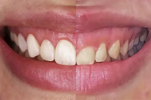 Gummy smile treatment illustration