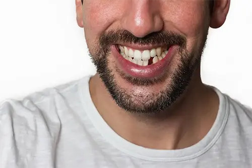 Missing teeth correction illustration for smile designing at Cosmodontist Clinic