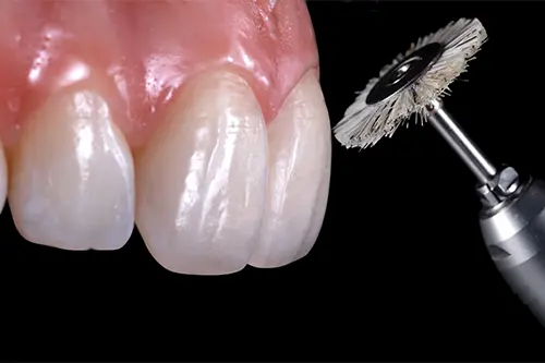 Tooth texture and characterization in smile designing illustration