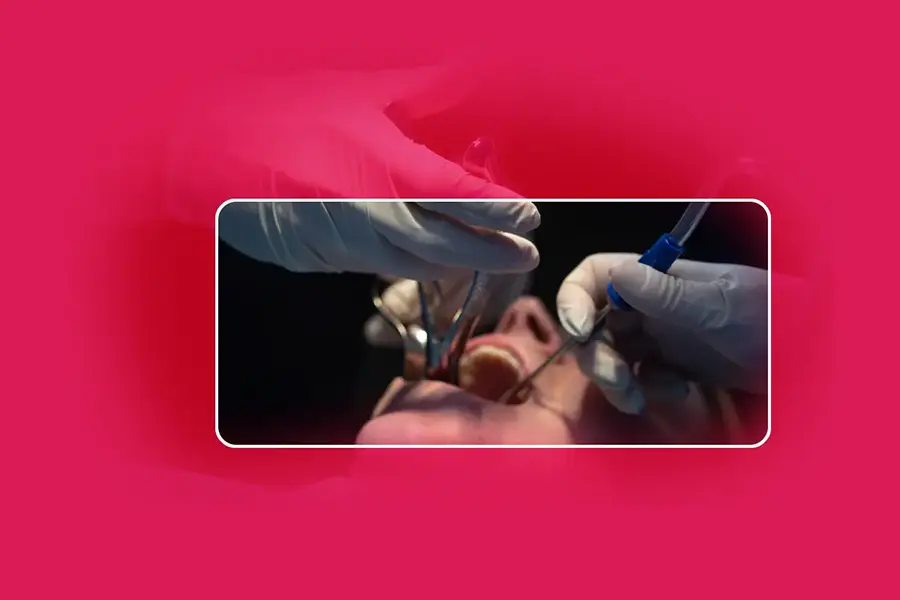Wisdom Tooth Extraction in Gurgaon