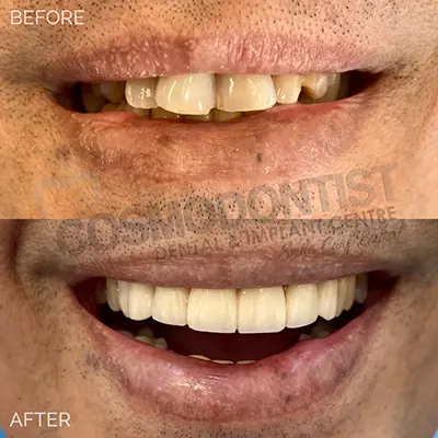 Tooth-colored restoration treatment illustration