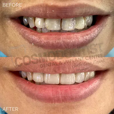 Tooth-colored dental filling illustration
